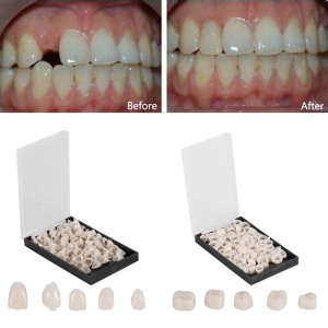 50Pcs/Box Dental Crowns Resin Porcelain Materials Temporary Teeth Crown Realistic Oral Care Teeth Whitening Anterior Molar Crown