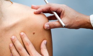 Mole, Skin Tag, Wart, Cyst, Brown Spot or Milia Removal at Bath Street Cosmetic