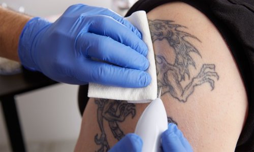 Tattoo Removal on Areas Up to 4cm x 4cm at Yorkshire Laser and Aesthetic (Up to 0% Off)